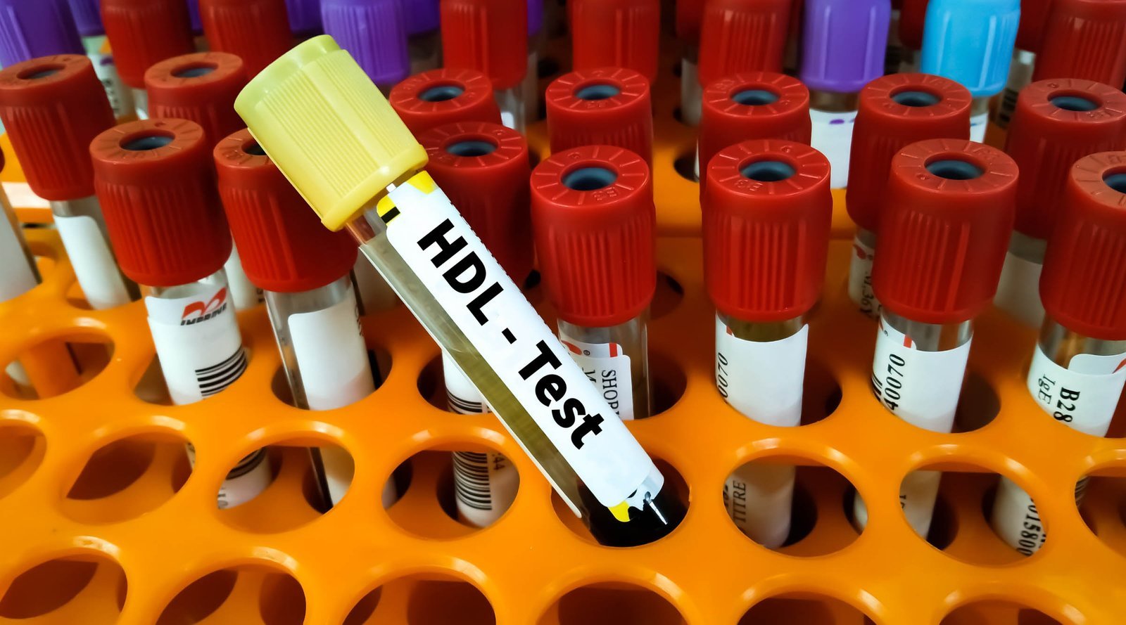 Dislipidemia: Entenda a relação entre colesterol, triglicerídeos e a saúde do coração.