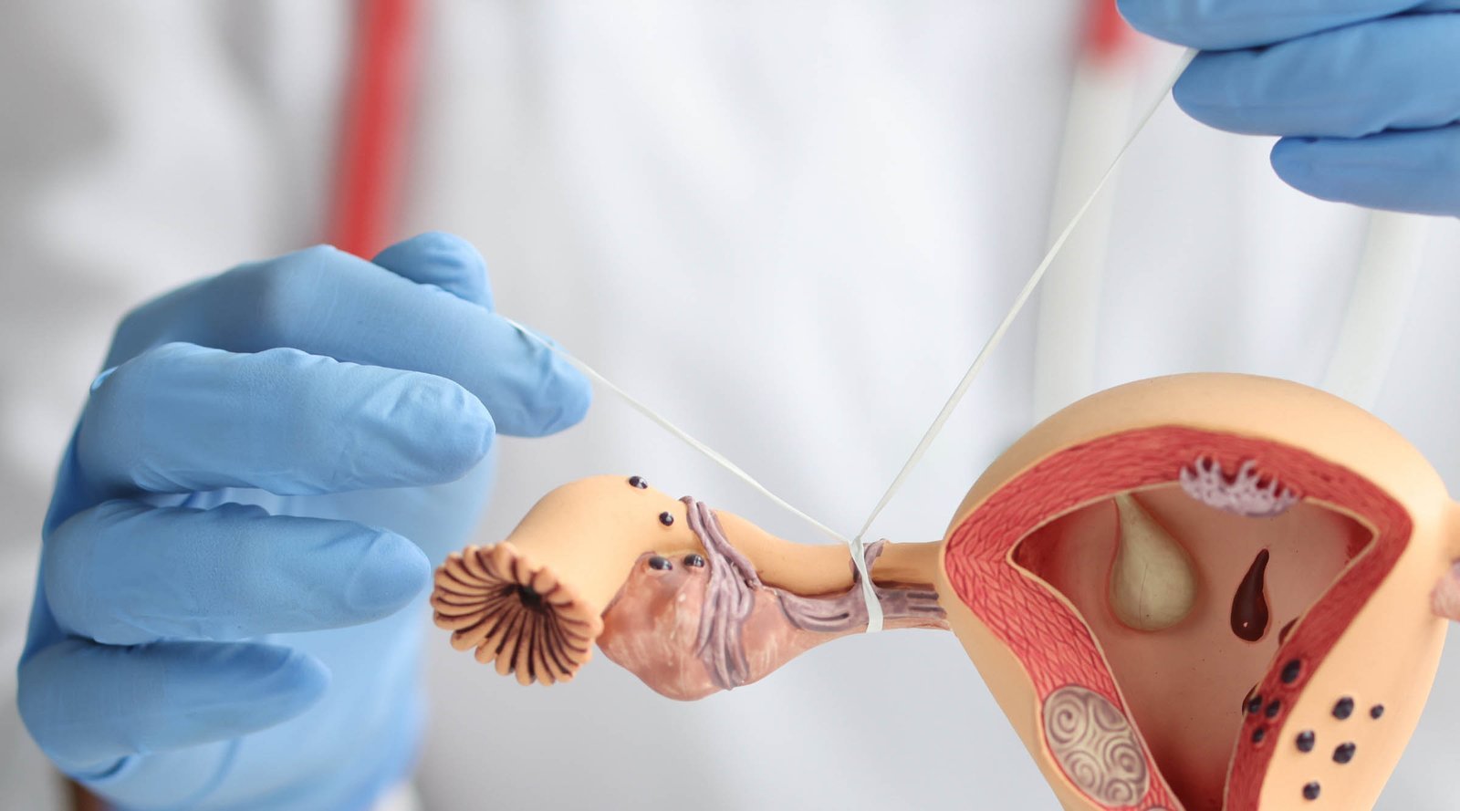 Laqueadura Tubária: O que você precisa saber sobre a cirurgia.