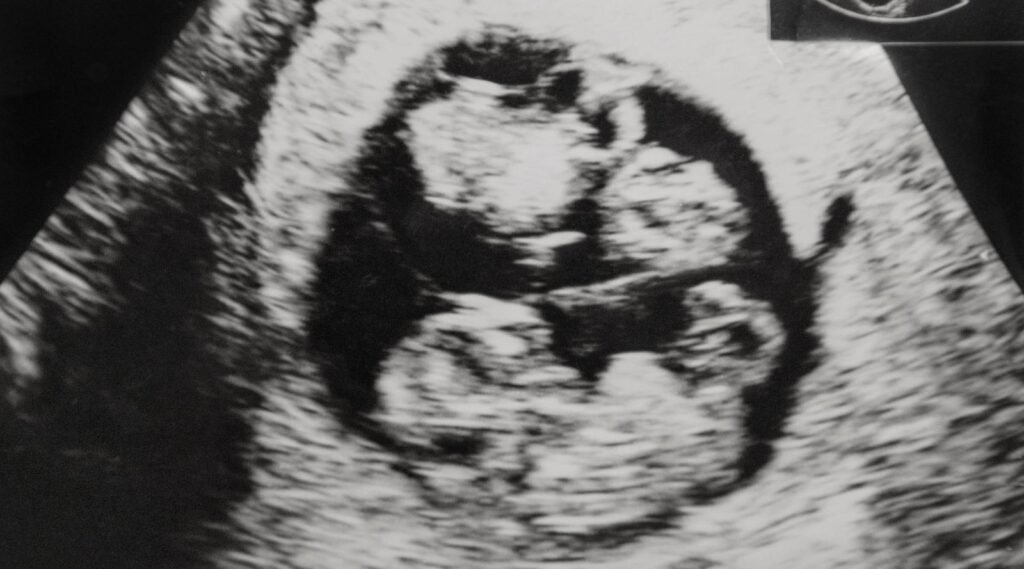 Gravidez Gemelar: Cuidados especiais no pré-natal e no parto.